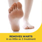 Dr. Scholl's Freeze Away Wart Remover for Hands & Feet, 12 ct – Removes Warts Fast in as Little as 1 Treatment, Fast-Acting Treatment for Common and Plantar Wart Removal, Safe to Use on Kids Ages 4+